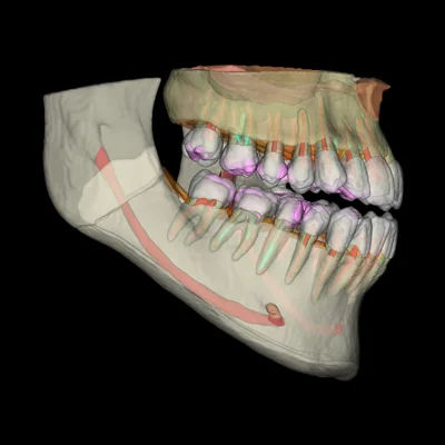 CBCT 3D snimak u Cranex BL, Banja Luka